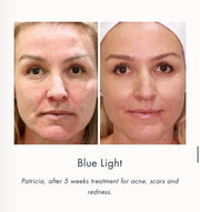 Magic Glow LED Face And Neck Beauty Light, Current Body Skin LED Light Therapy Face Mask, Light Up Facial Mask LED Before and after 